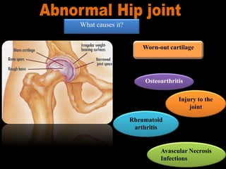 What causes it?
Osteoarthritis
Rheumatoid
arthritis
Worn-out cartilage
Injury to the
joint
Avascular Necrosis
Infections
 
