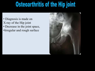 • Diagnosis is made on
X-ray of the Hip joint
• Decrease in the joint space,
•Irregular and rough surface
 