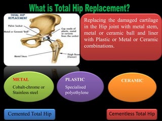 Replacing the damaged cartilage
in the Hip joint with metal stem,
metal or ceramic ball and liner
with Plastic or Metal or Ceramic
combinations.
METAL
Cobalt-chrome or
Stainless steel
PLASTIC
Specialised
polyethylene
CERAMIC
Cemented Total Hip Cementless Total Hip
 