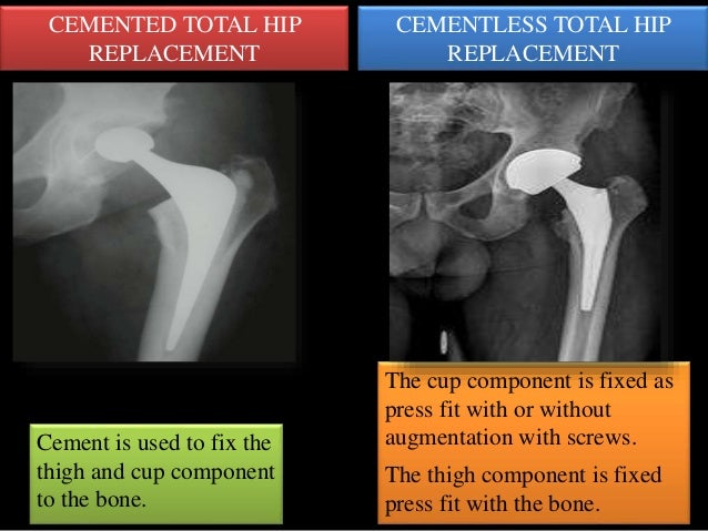 Total hip replacement