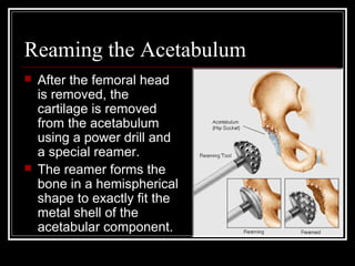 Totalhipreplacement.. haider | PPT