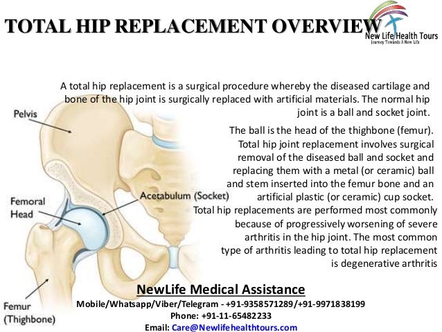 Total Hip Replacement in India