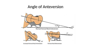 Comprehensive Overview of Hip Arthroplasty: Indications, Techniques ...