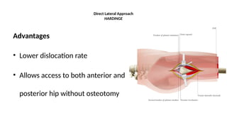 Direct Lateral Harding Approach Comprehensive Overview of Hip Arthroplasty: Indications, Techniques ...