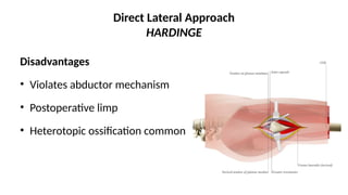 Direct Lateral Harding Approach Comprehensive Overview of Hip Arthroplasty: Indications, Techniques ...