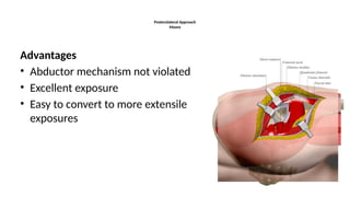 Moore Approach Comprehensive Overview of Hip Arthroplasty: Indications, Techniques ...