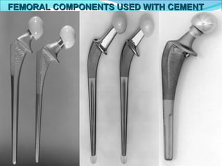  The stem fabricated of high strength super alloy (Cobalt
– Chrome )has been favoured by some designers
because of its higher modulus of elasticity, may decrease
stresses within the proximal cement mantle.
The cross section of the stem should have broad medial
and lateral border to load the proximal cement mantle
in compression.
Sharp edges should be avoided. .
The bond between prosthesis and the cement is
improved by surface macrotexturing .
 A collar aids in determining depth of insertion and
may diminish resorption of bone in the medial neck.
FEMORAL COMPONENTS USED WITH CEMENTFEMORAL COMPONENTS USED WITH CEMENT
 