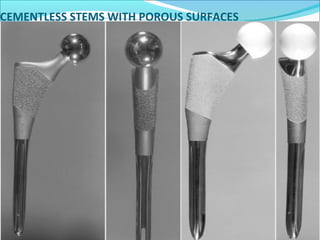 CEMENTLESS STEMS WITH POROUS SURFACES
Currently available porous coated stress designs are
made up of :
Titanium – vanadium-aluminum alloy with porous surfaces of
pure titanium fibre mesh or beads.
Cobalt – chromium alloy with sintered beaded surface.
The advantages of cementless femoral stem prosthesis :
No cement is required and problems related to cement are
eliminated.
Applicability in young and active patients and in revision THR.
Circumferential porous coating of proximal stem provides more
effective barrier to ingress of particle and thus limits early
development of osteolysis in distal stem
Decreased incidence of aseptic loosening.
Less bone destruction.
 