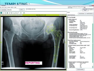 TEMPLATING :
Draw two horizontal lines : One joining both ischial tuberosites
and the other joining lesser trochanter. Measure limb length
discrepancy as the difference in lengths of lesser trochanters.
Aetabulum : Place acetabular templates on the film and select a
size that closely matches the contour of patients acetabulum. The
medial surface of the cup is at the teardrop and the inferior limit
is at the level of obturator foramen.
Femur : Select a size that most precisely matches the contour of
proximal canal with 2-3 mm of cement mantle. Select a neck
length so that the difference in the height of femoral and
acetabular center is equal to the limb length discrepancy.
Mark the level of anticipated neck cut and measure its distance
from the lesser trochanter.
 