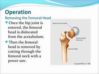 Operation
Removing the Femoral Head
Once the hip joint is
entered, the femoral
head is dislocated
from the acetabulum.
Then the femoral
head is removed by
cutting through the
femoral neck with a
power saw.
 