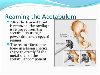 Reaming the Acetabulum
After the femoral head
is removed, the cartilage
is removed from the
acetabulum using a
power drill and a special
reamer.
The reamer forms the
bone in a hemispherical
shape to exactly fit the
metal shell of the
acetabular component.
 