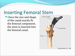 Inserting Femoral Stem
Once the size and shape
of the canal exactly fit
the femoral component,
the stem is inserted into
the femoral canal.
 