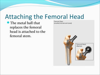 Attaching the Femoral Head
The metal ball that
replaces the femoral
head is attached to the
femoral stem.
 