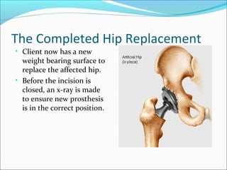 The Completed Hip Replacement
• Client now has a new
weight bearing surface to
replace the affected hip.
• Before the incision is
closed, an x-ray is made
to ensure new prosthesis
is in the correct position.
 