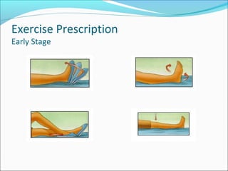 Exercise Prescription
Early Stage
 
