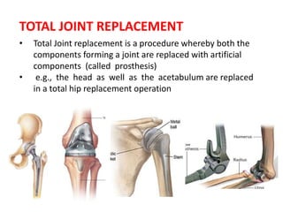 Total joint replacement, Dr Arun C Raj, Ortho Resident KIMS, Hubli | PPTX