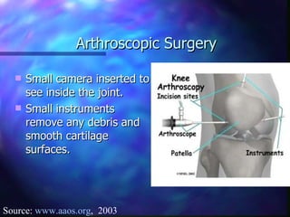 Arthroscopic Surgery Small camera inserted to see inside the joint. Small instruments remove any debris and smooth cartilage surfaces. Source:  www.aaos.org ,  2003 