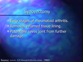 Synovectomy Early stages of rheumatoid arthritis. Removes inflamed tissue lining. Potentially saves joint from further damage. Source:  www.AllAboutArthritis.com  , 2003 