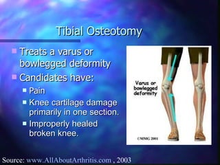 Tibial Osteotomy Treats a varus or bowlegged deformity Candidates have: Pain  Knee cartilage damage primarily in one section. Improperly healed broken knee. Source:  www.AllAboutArthritis.com  , 2003 