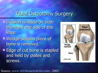 Tibial Osteotomy Surgery Incision is made on both the front and side of the knee. Wedge-shaped piece of bone is removed. Edge of cut bone is stapled and held by plates and screws. Source:  www.AllAboutArthritis.com  , 2003 