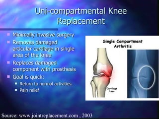 Uni-compartmental Knee Replacement Minimally invasive surgery Removes damaged articular cartilage in single area of the knee Replaces damaged component with prosthesis Goal is quick: Return to normal activities. Pain relief Source: www.jointreplacement.com , 2003 