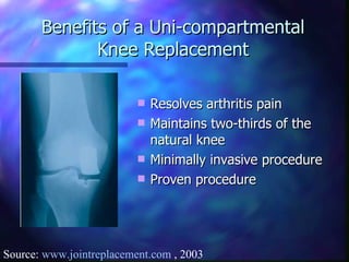 Benefits of a Uni-compartmental Knee Replacement Resolves arthritis pain Maintains two-thirds of the natural knee  Minimally invasive procedure Proven procedure Source:  www.jointreplacement.com  , 2003 