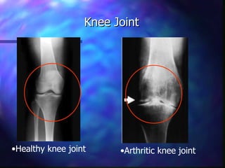 Knee Joint Healthy knee joint Arthritic knee joint 