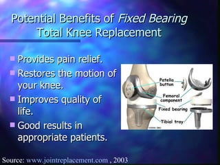 Potential Benefits of  Fixed Bearing  Total Knee Replacement Provides pain relief. Restores the motion of your knee. Improves quality of life. Good results in appropriate patients. Source:  www.jointreplacement.com  , 2003 