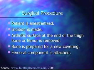 Surgical Procedure Patient is anesthetized. Incision is made. Arthritic surface at the end of the thigh bone or femur is removed. Bone is prepared for a new covering. Femoral component is attached. Source:  www.Jointreplacement.com , 2003 