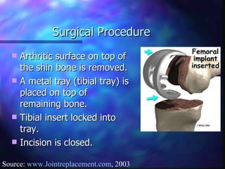 Surgical Procedure Arthritic surface on top of the shin bone is removed. A metal tray (tibial tray) is placed on top of remaining bone. Tibial insert locked into tray. Incision is closed. Source:  www.Jointreplacement.com , 2003 