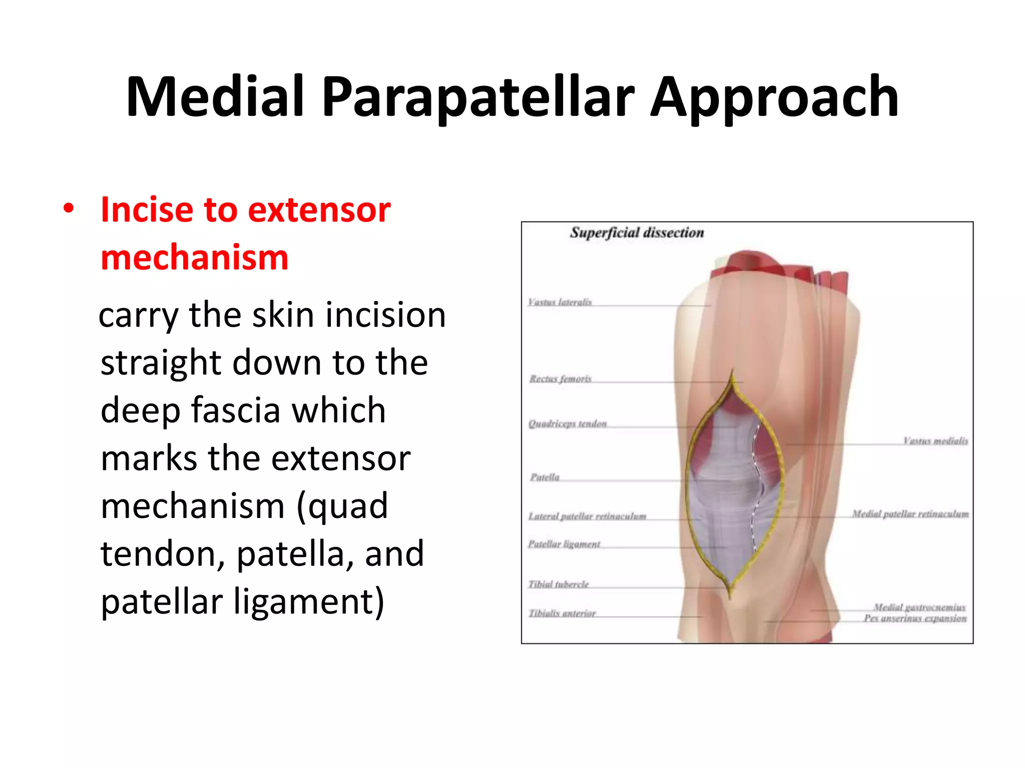 Total knee approaches | PPTX