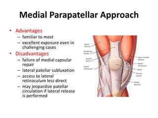 Total knee approaches | PPTX