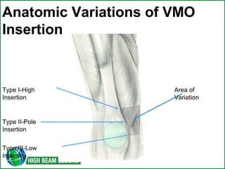 Vmo Total knee arthroplasty | PPT