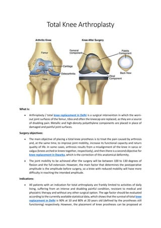 Total Knee Arthroplasty
What is:
• Arthroplasty / total knee replacement in Delhi is a surgical intervention in which the worn-
out joint surfaces of the femur, tibia and often the kneecap are replaced, as they are a source
of disabling pain. Metallic and high-density polyethylene components are placed in place of
damaged and painful joint surfaces.
Surgery objectives:
• The main objective of placing a total knee prosthesis is to treat the pain caused by arthrosis
and, at the same time, to improve joint mobility, increase its functional capacity and return
quality of life. In some cases, arthrosis results from a misalignment of the knee in varus or
valgus (knees arched or knees together, respectively), and then there is a second objective for
knee replacement in Dwarka, which is the correction of this anatomical deformity.
• The joint mobility to be achieved after the surgery will be between 100 to 130 degrees of
flexion and the full extension. However, the main factor that determines the postoperative
amplitude is the amplitude before surgery, so a knee with reduced mobility will have more
difficulty in reaching the intended amplitude.
Indications:
• All patients with an indication for total arthroplasty are frankly limited to activities of daily
living, suffering from an intense and disabling painful condition, resistant to medical and
physiatric therapy and without any other surgical option. The age factor should be evaluated
according to the currently available statistical data, which shows that the survival of total knee
replacement in Delhi is 90% at 10 and 80% at 20 years old (defined by the prostheses still
functioning) respectively. However, the placement of knee prostheses can be proposed at
 