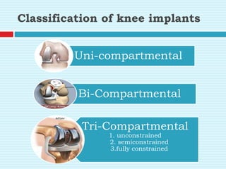 Classification of knee implants
Uni-compartmental
Bi-Compartmental
Tri-Compartmental
1. unconstrained
2. semiconstrained
3.fully constrained
 