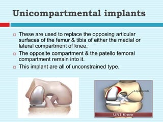Unicompartmental implants
 These are used to replace the opposing articular
surfaces of the femur & tibia of either the medial or
lateral compartment of knee.
 The opposite compartment & the patello femoral
compartment remain into it.
 This implant are all of unconstrained type.
 