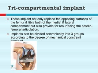 Tri-compartmental implant
 These implant not only replace the opposing surfaces of
the femur & tibia both of the medial & lateral
compartment but also provide for resurfacing the patello-
femoral articulation.
 Implants can be divided conveniently into 3 groups
according to the degree of mechanical constraint
provided.
 