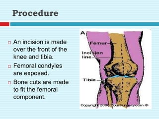 Procedure
 An incision is made
over the front of the
knee and tibia.
 Femoral condyles
are exposed.
 Bone cuts are made
to fit the femoral
component.
 