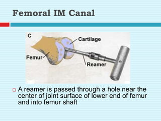 Femoral IM Canal
 A reamer is passed through a hole near the
center of joint surface of lower end of femur
and into femur shaft
 