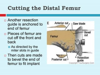Cutting the Distal Femur
 Another resection
guide is anchored to
end of femur
 Pieces of femur are
cut off the front and
back
 As directed by the
miter slots in guide
 Then cuts are made
to bevel the end of
femur to fit implant
 