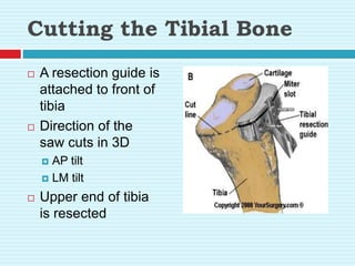 Cutting the Tibial Bone
 A resection guide is
attached to front of
tibia
 Direction of the
saw cuts in 3D
 AP tilt
 LM tilt
 Upper end of tibia
is resected
 