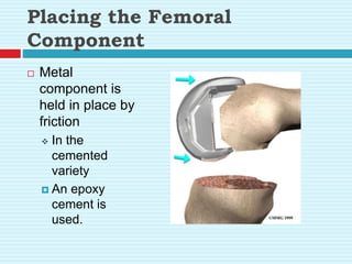 Placing the Femoral
Component
 Metal
component is
held in place by
friction
 In the
cemented
variety
 An epoxy
cement is
used.
 