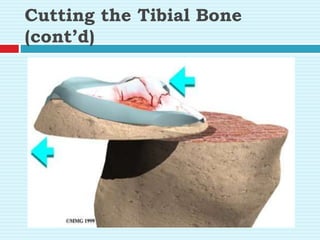 Cutting the Tibial Bone
(cont’d)
 