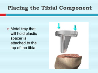 Placing the Tibial Component
 Metal tray that
will hold plastic
spacer is
attached to the
top of the tibia
 