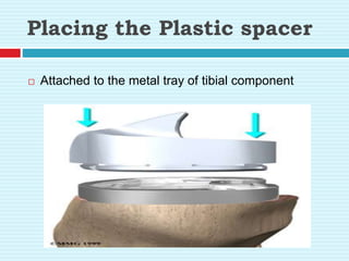 Placing the Plastic spacer
 Attached to the metal tray of tibial component
 