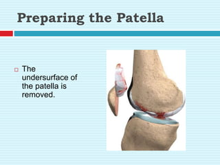 Preparing the Patella
 The
undersurface of
the patella is
removed.
 