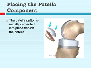 Placing the Patella
Component
 The patella button is
usually cemented
into place behind
the patella
 