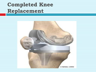 Completed Knee
Replacement
 
