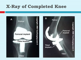 X-Ray of Completed Knee
 