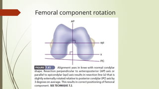 Femoral Component Rotation Total knee arthroplasty( campbell) .pptx